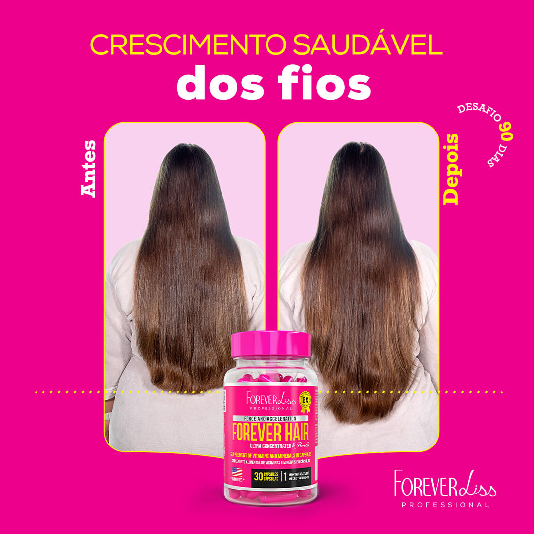 Combo Tratamento 6 Meses Forever Hair Crescimento Capilar